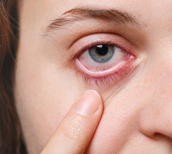 Jęczmień na oku – objawy, przyczyny i domowe sposoby leczenia